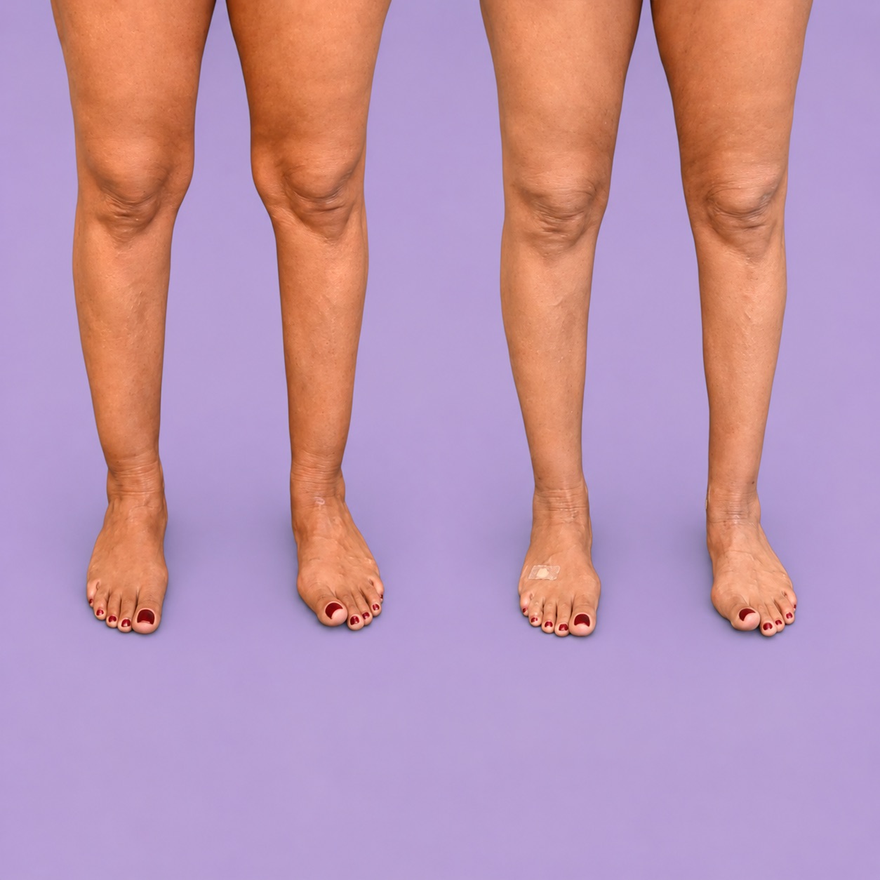 Lipedema grau 1 — comparativo pré e pós lipoaspiração