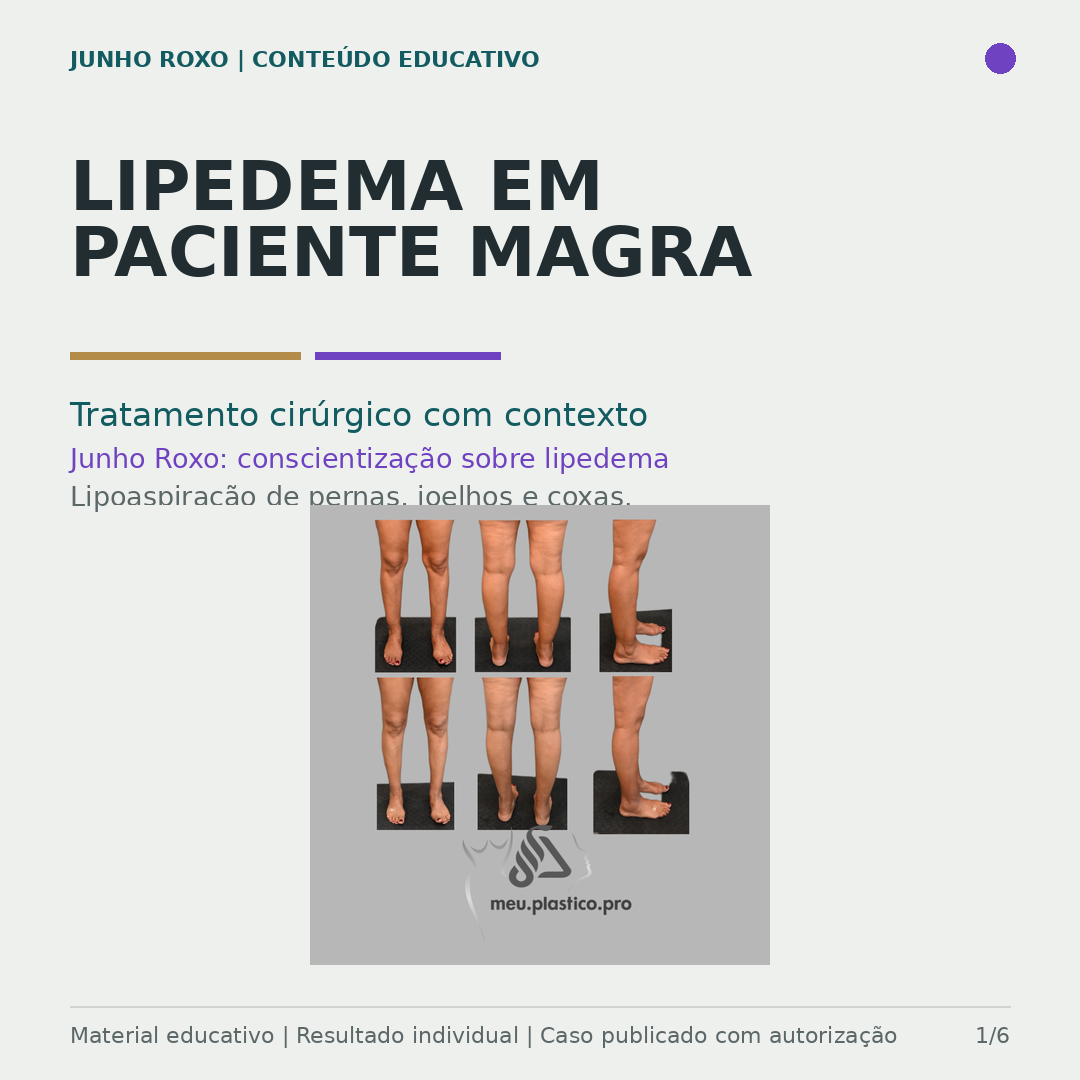 Junho Roxo — Lipedema em paciente magra
