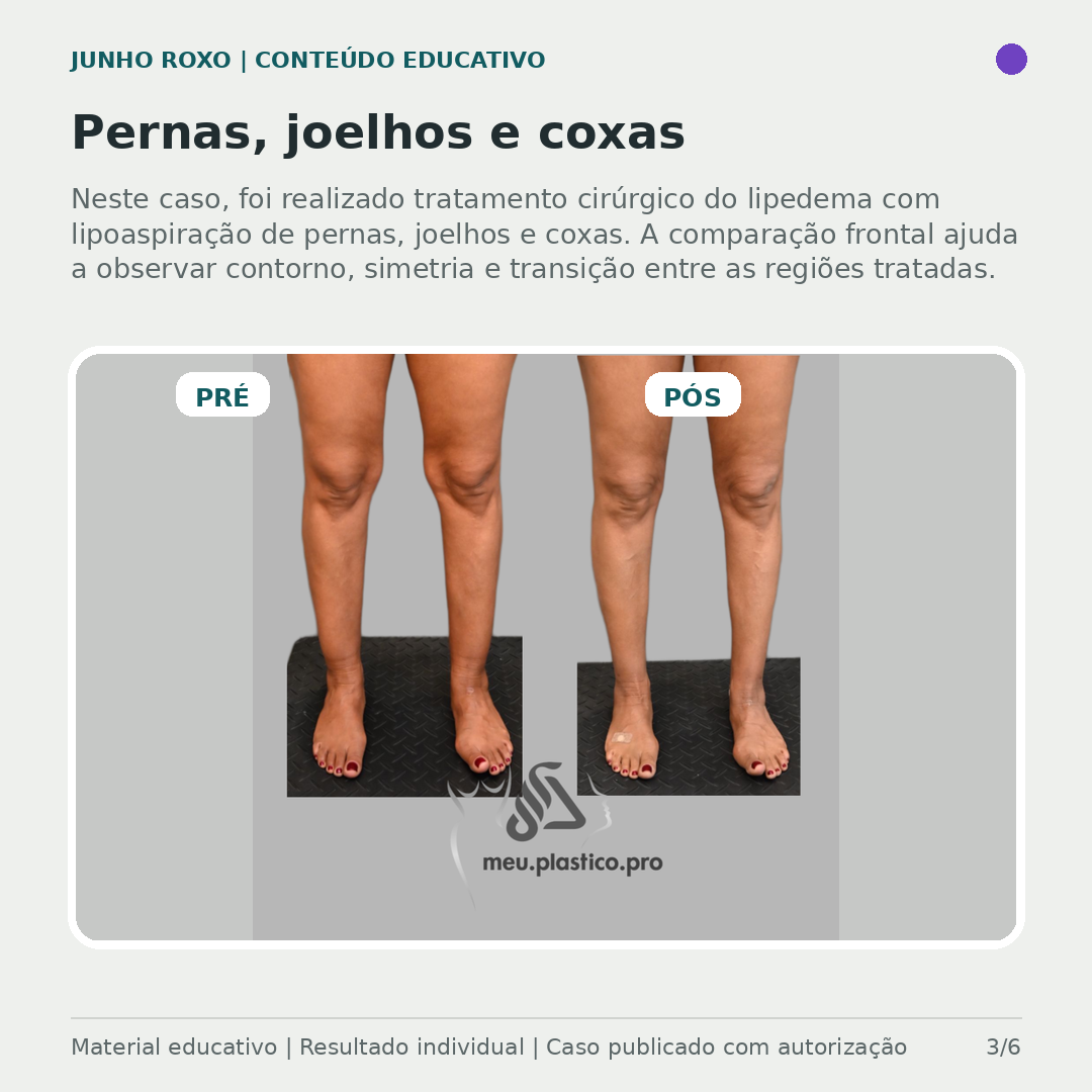 Pernas, joelhos e coxas — pré e pós